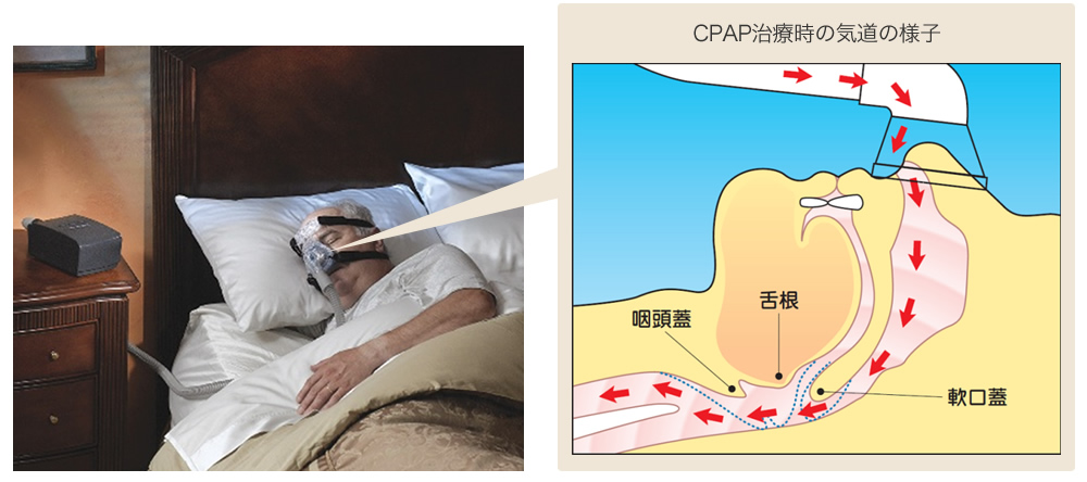 CPAP