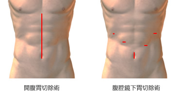 開腹胃切除術・腹腔鏡下胃切除術