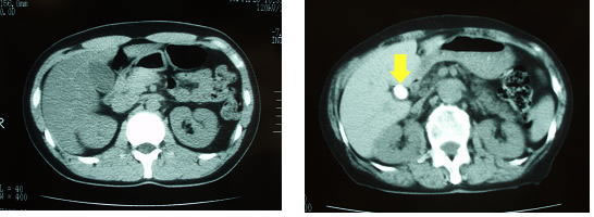 CT(X腺断層撮影)