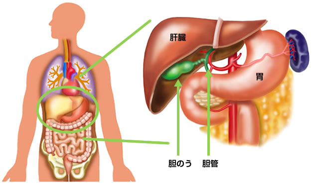 結石 胆嚢