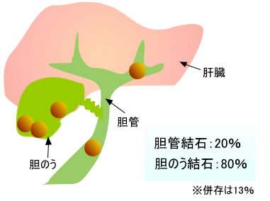 胆石症の分類