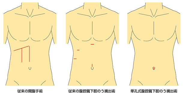 胆石症の手術方法