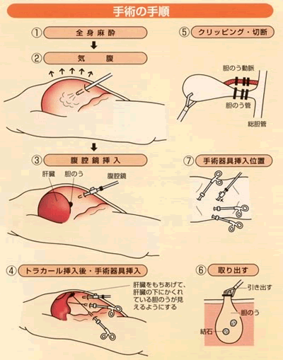 胆石症の手術方法