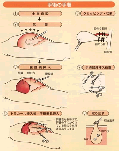 手術の手順