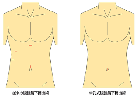 胆石症の手術方法