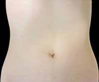 単孔式腹腔鏡下手術のメリット