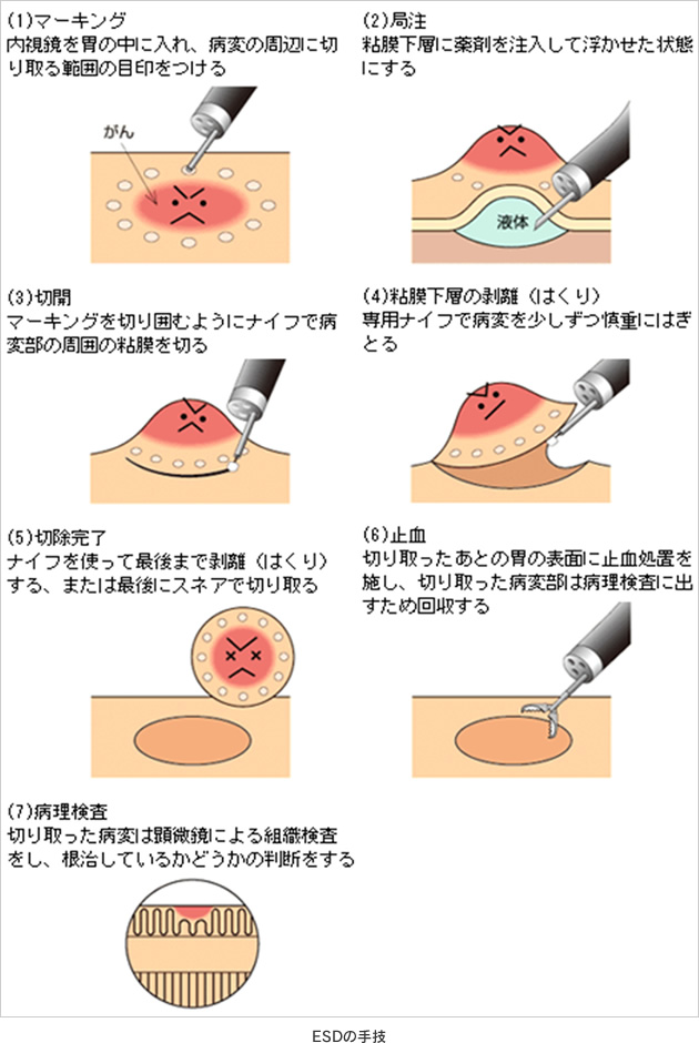 ESDの手技