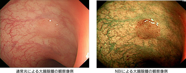 左：通常光による大腸腺腫の観察像例
　右：NBIによる大腸腺腫の観察像例