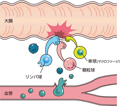 L-CAP・G-CAP療法 | 医療法人 佐田厚生会 佐田病院（福岡）