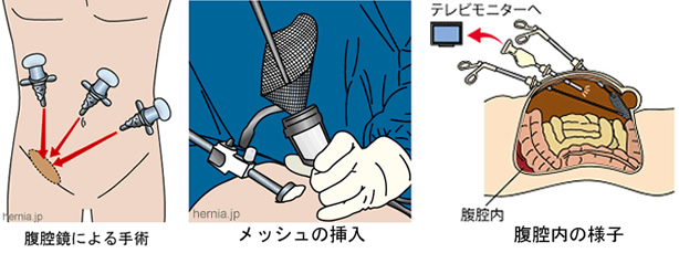 ソケイヘルニアと診断されたら