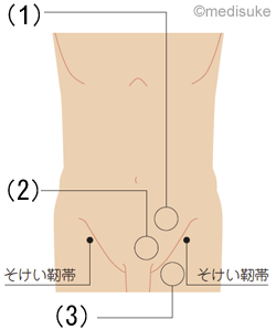 ソケイヘルニアの3つの種類