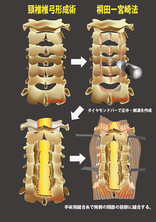 頚椎後面図