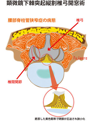 腰部脊柱管狭窄症の病態