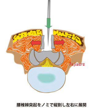 腰椎棘突起をノミで縦割し左右に展開