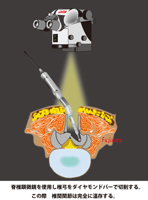 脊椎顕微鏡を使用し椎弓をダイヤモンドバーで切削する。この際椎間は完全に温存する。