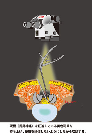 硬膜（馬尾神経）を圧迫している黄色靭帯を持ち上げ、硬膜を損傷しないようにしながら切除する。