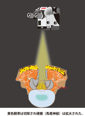 黄色靭帯は切除され硬膜（馬尾神経）は拡大された。