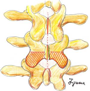 腰椎後方経路椎体間固定術