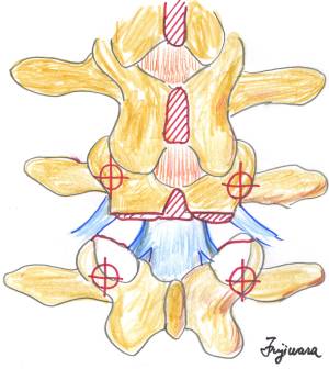 腰椎後方経路椎体間固定術