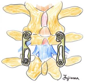 腰椎後方経路椎体間固定術