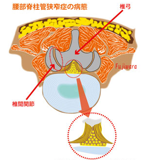 肥厚した黄色靭帯で硬膜が圧迫され狭小化