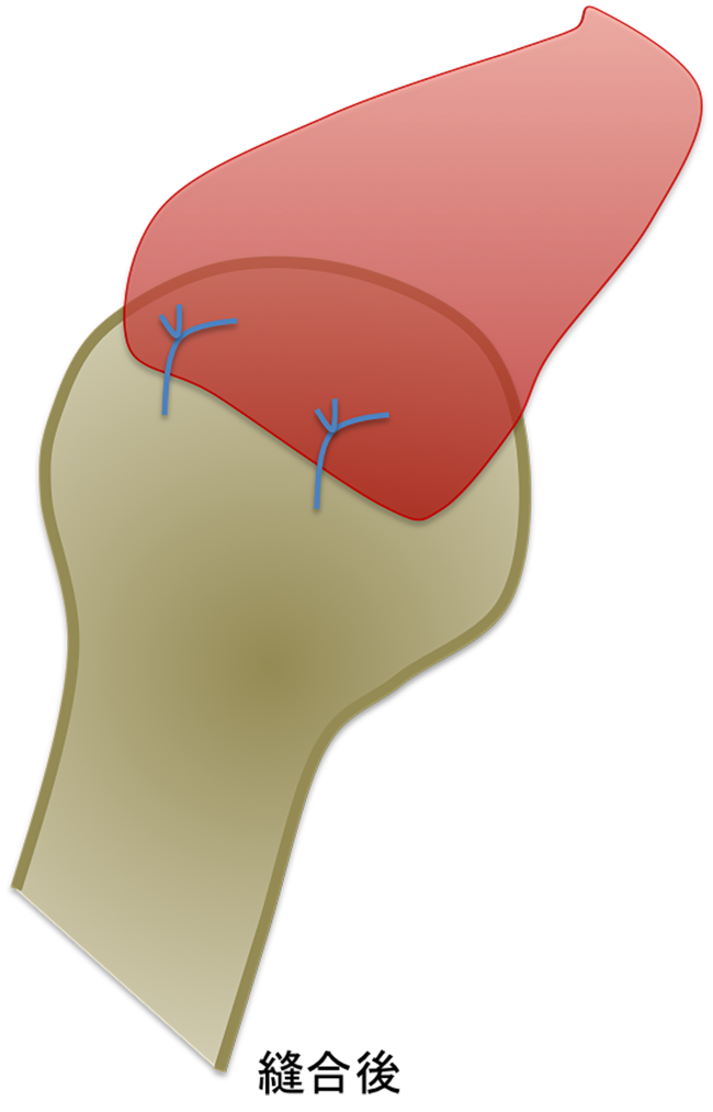 写真２での縫合後の模式図です。特殊なネジ（アンカー）を用いて縫合しています。